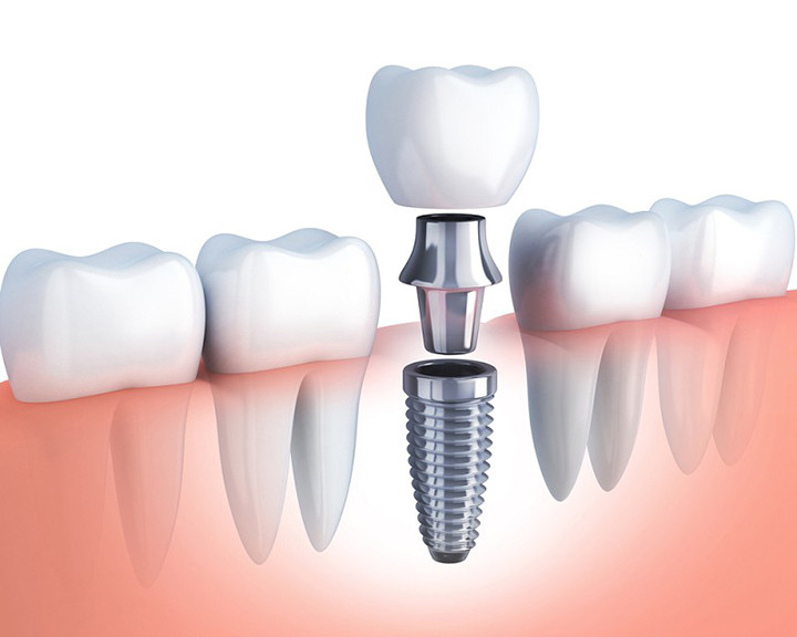 Trồng Răng Implant có đau không? và những điều cần biết